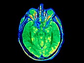 False-colour MRI scan of the head,axial section