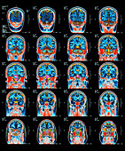 Healthy brain,MRI scans