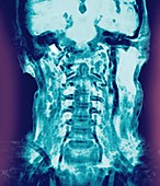 Normal head and neck,MRI scan