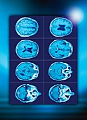 Normal brain,CT scans