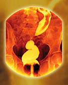 Rectal cancer,X-ray