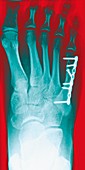 Pinned foot bone fracture,X-ray