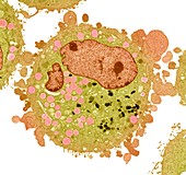 Carcinoma cell,TEM