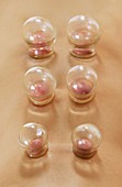 Cupping