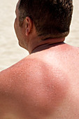 Sunburnt skin