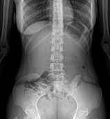 Normal abdomen,X-ray
