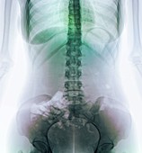 Normal abdomen,X-ray