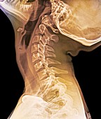 Normal extended neck,X-ray