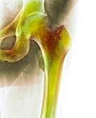 Normal hip,X-ray