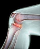 Arthritis of the knee,X-ray