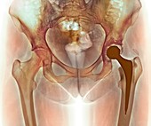 Loosened hip replacement,X-ray