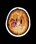 Brain abscess,CT scan