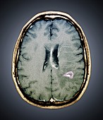 Tapeworm cyst in the brain,MRI scan