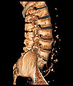 Degenerative disc disease,3D CT scan