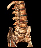 Degenerative disc disease,3D CT scan