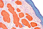 Skin cancer,light micrograph