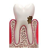 Dental plaque,artwork
