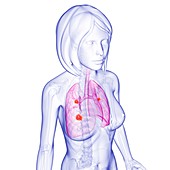 Female lung cancer,artwork