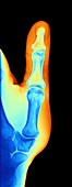 Arthrosis of the hand,X-ray