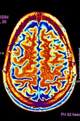 Brain scan,MRI scan