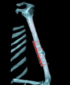 Pinned arm fracture,3D CT scan