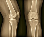 Healthy knee,X-ray