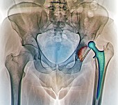 Dislocated hip replacement,X-ray