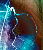 Coronary stent,X-ray