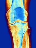 Knee joint,x-ray