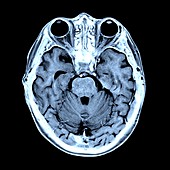 Coloured MRI scan of the human head