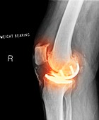 Osteoarthritis of the knee,X-ray