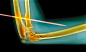 Knitting needle through arm,X-ray