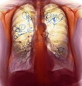 Endobronchial valves,X-ray