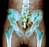 Foreign object in rectum,X-ray
