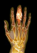 Foreign body in finger,X-ray