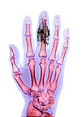 Foreign body in finger,X-ray