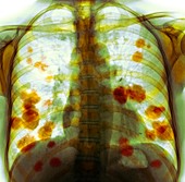 Secondary lung cancer,X-ray