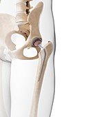 Human hip replacement,artwork