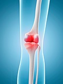 Human knee pain,artwork