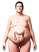 Large intestine of overweight man