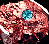 Brain haemorrhage,3D angiogram
