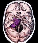 Benign brain tumour,CT scan