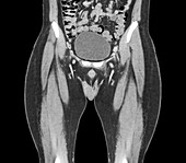 Healthy bladder,CT scan