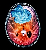Benign brain tumour,CT scan