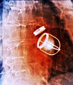 Artificial heart valves,X-ray