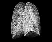 Healthy lungs,CT scan