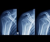 Injured shoulder,X-rays