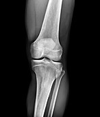 Normal knee,X-rays