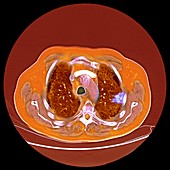 Lung cancer,CT scan