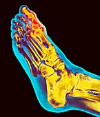 Degenerative foot deformation,X-ray